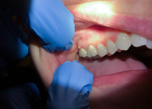 Best Chipped Tooth Repair Near Me  in Privateer, SC